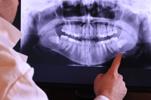 Best Emergency Dental Extractions in Wollochet, WA